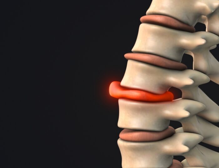 At What Point Does A Bulging Disc Require Surgery