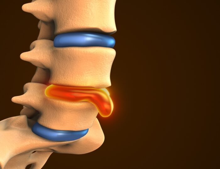 Does A Bulging Disc Ever Heal Itself