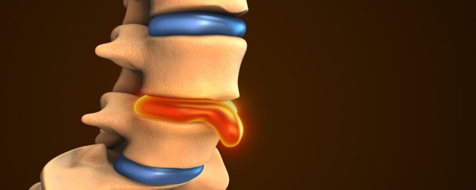 Does A Bulging Disc Ever Heal Itself