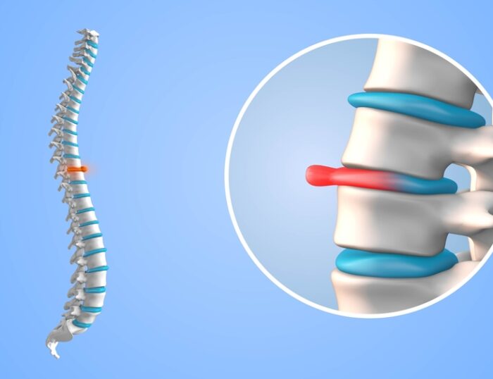 How Serious Is A Bulging Disc In Your Back