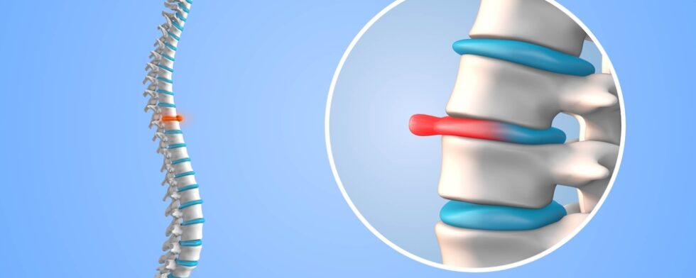 How Serious Is A Bulging Disc In Your Back