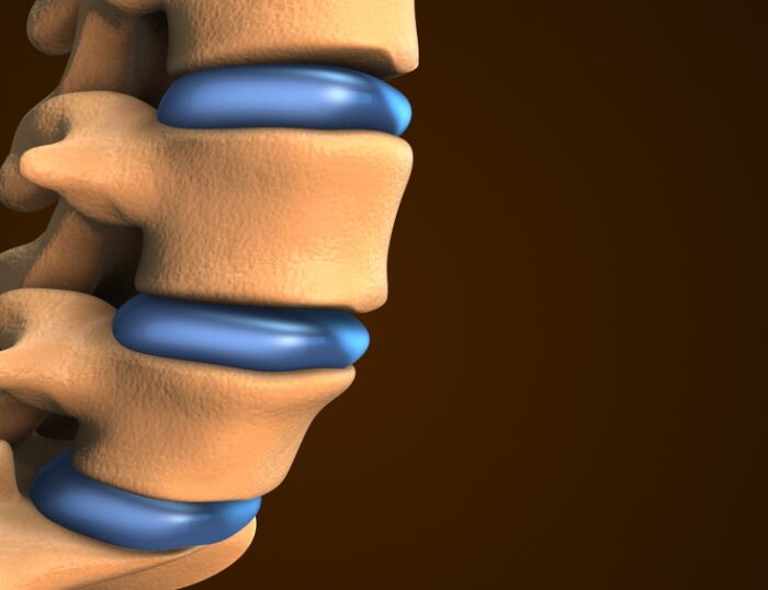 Is A Disc Bulge A Serious Problem