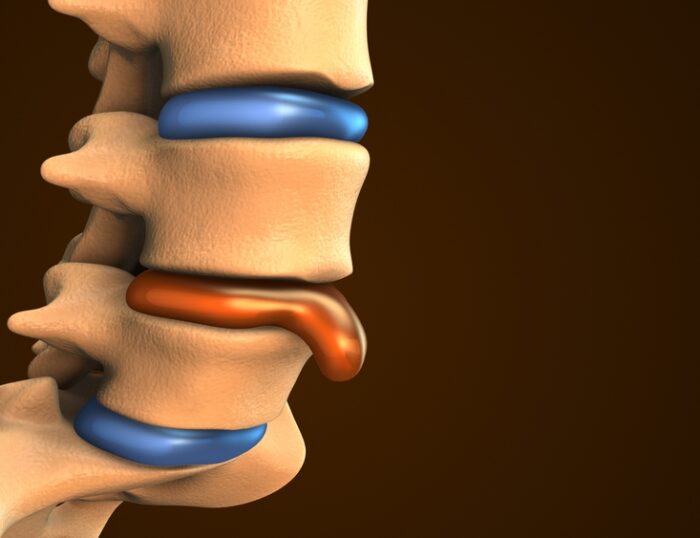 Is Heat Or Cold Better For A Bulging Disc
