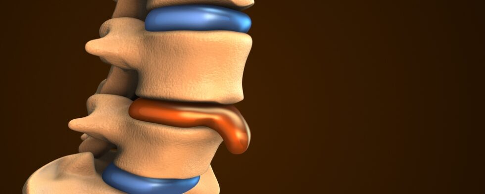 Is Heat Or Cold Better For A Bulging Disc