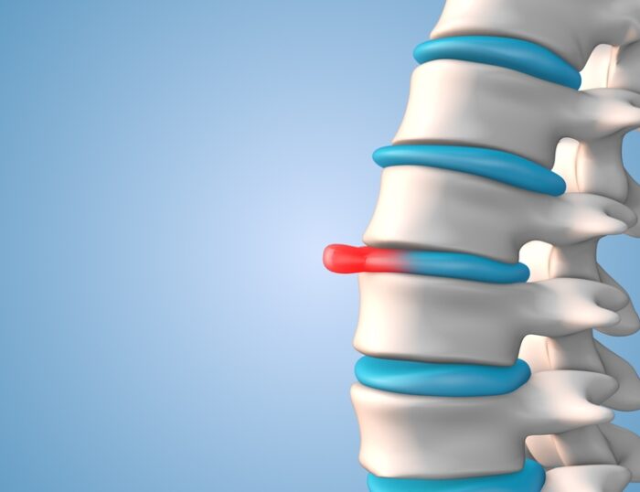 What Activities Should I Avoid With A Bulging Disc