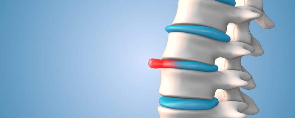 What Activities Should I Avoid With A Bulging Disc