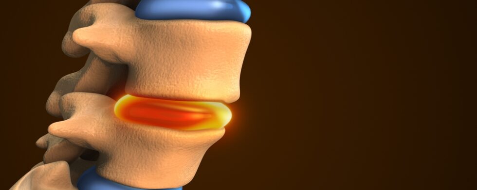 What Are The 5 Stages Of A Herniated Disc