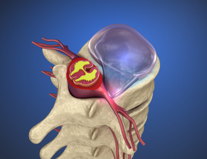 What Can Be Mistaken For A Herniated Disc