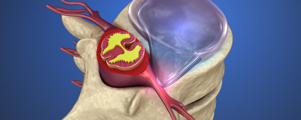 What Can Be Mistaken For A Herniated Disc