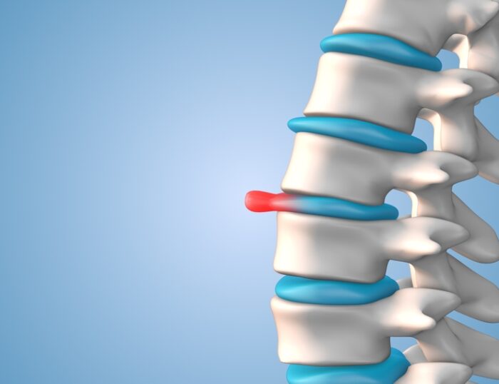 What Shouldn't You Do With A Bulging Disc
