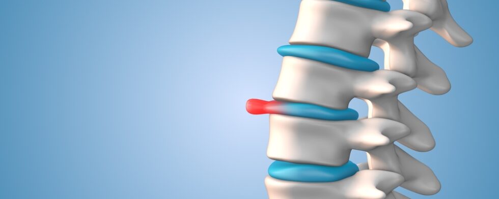 What Shouldn't You Do With A Bulging Disc