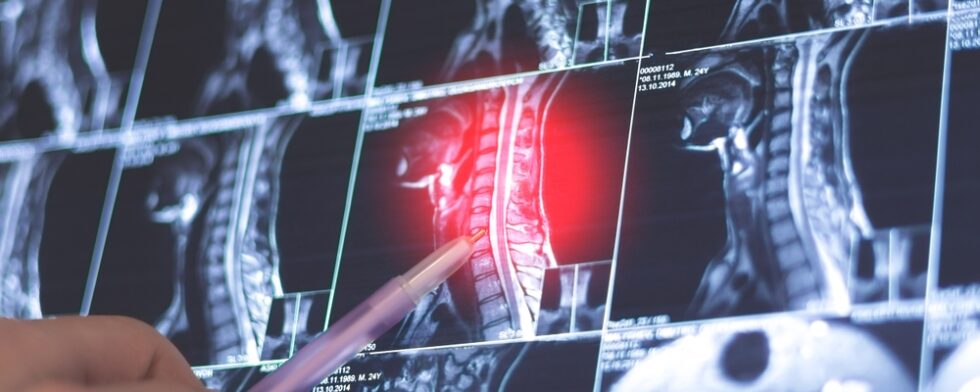 What's The Average Price For Spinal Decompression