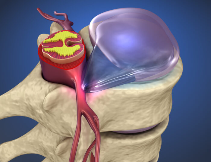When To Be Concerned About A Bulging Disc
