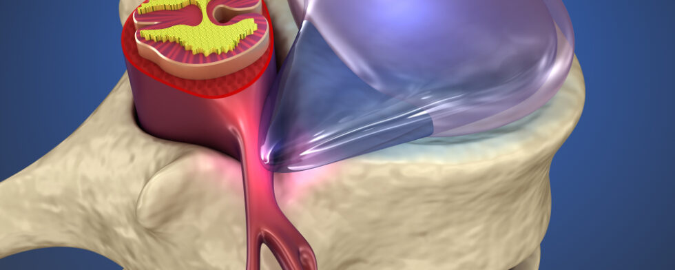 When To Be Concerned About A Bulging Disc