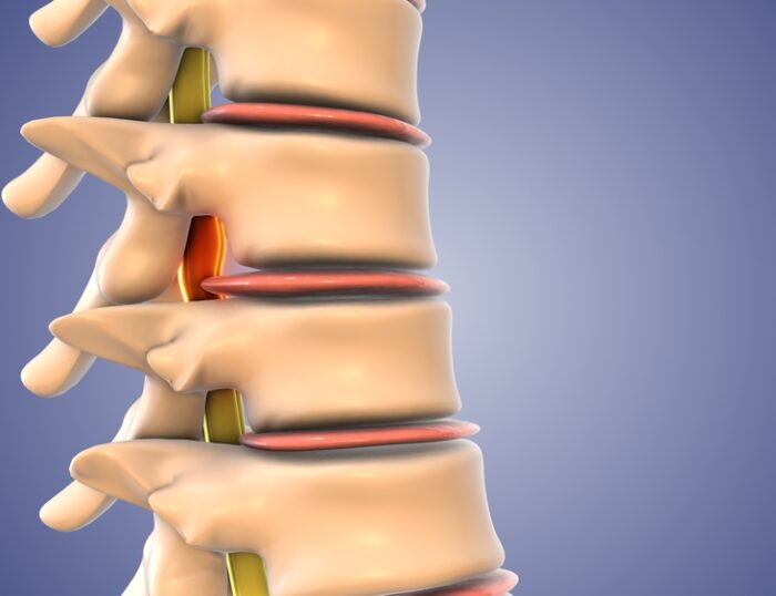 Why Doesn't Insurance Cover Spinal Decompression