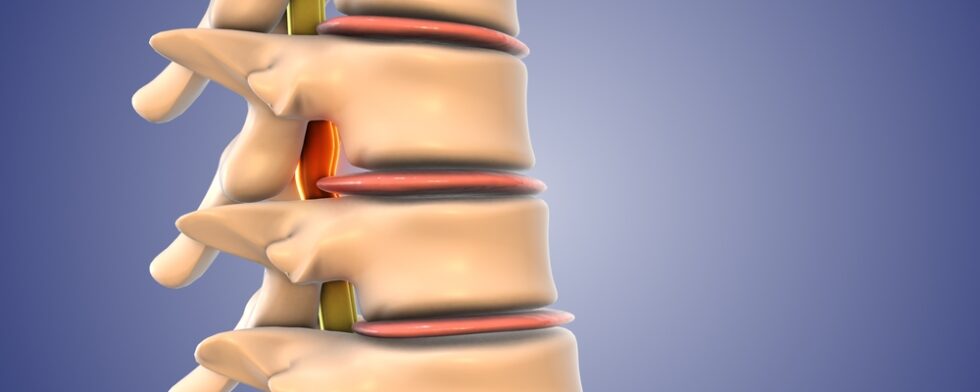Why Doesn't Insurance Cover Spinal Decompression