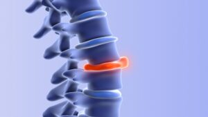 How Can I Check My Disc Bulge At Home