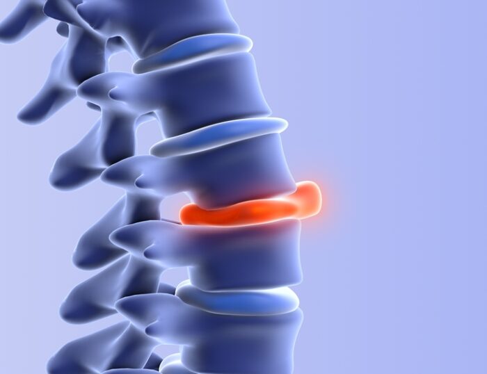 How Can I Check My Disc Bulge At Home