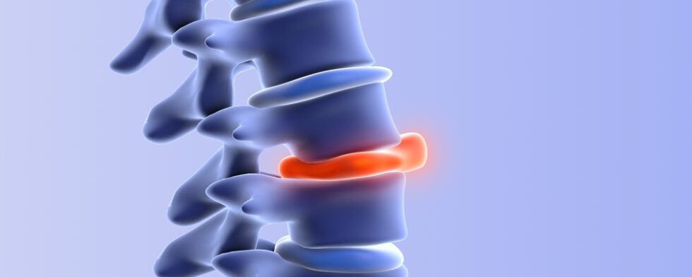 How Can I Check My Disc Bulge At Home