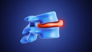 How Long Does It Take To Correct A Bulging Disc