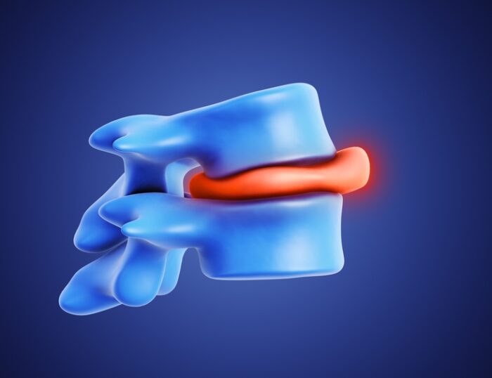 How Long Does It Take To Correct A Bulging Disc