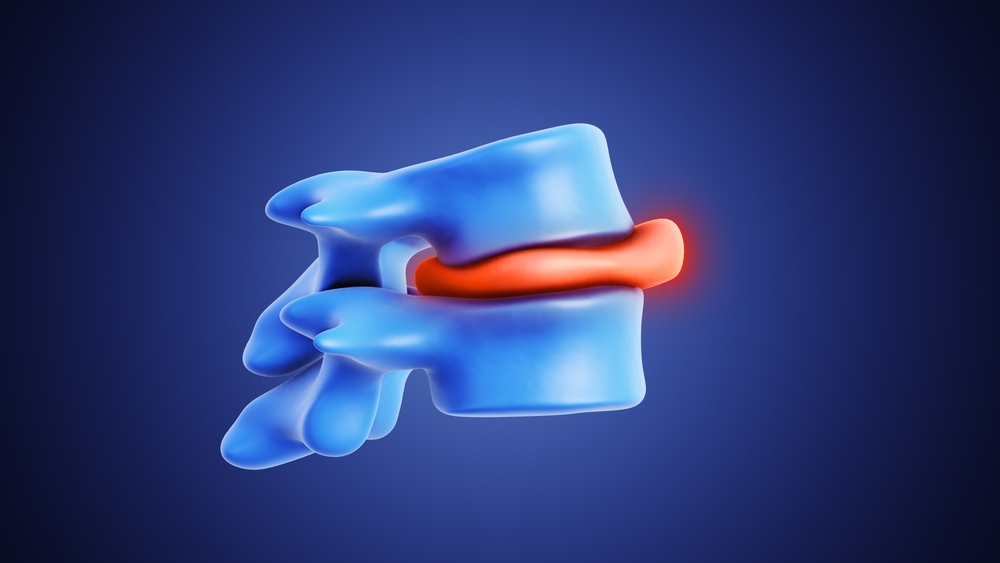 How Long Does It Take To Correct A Bulging Disc
