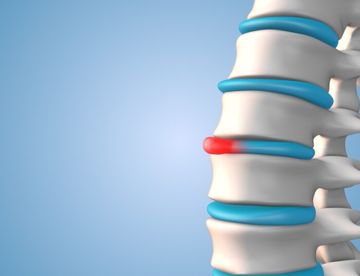 How To Know If A Bulging Disc Is Getting Worse
