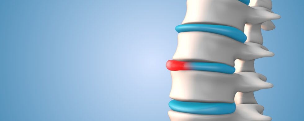 How To Know If A Bulging Disc Is Getting Worse