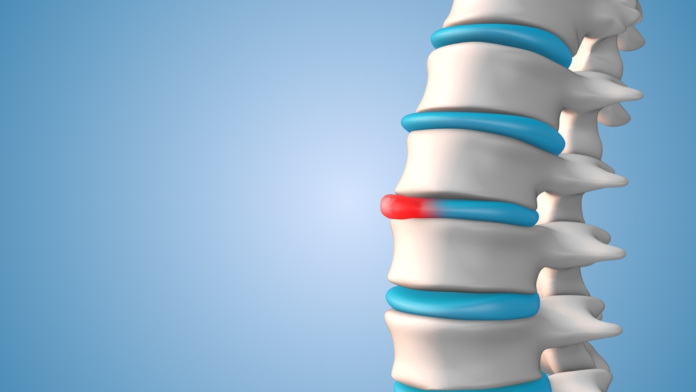 How To Know If A Bulging Disc Is Getting Worse
