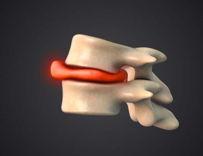 What Are The Red Flags Of A Herniated Disc