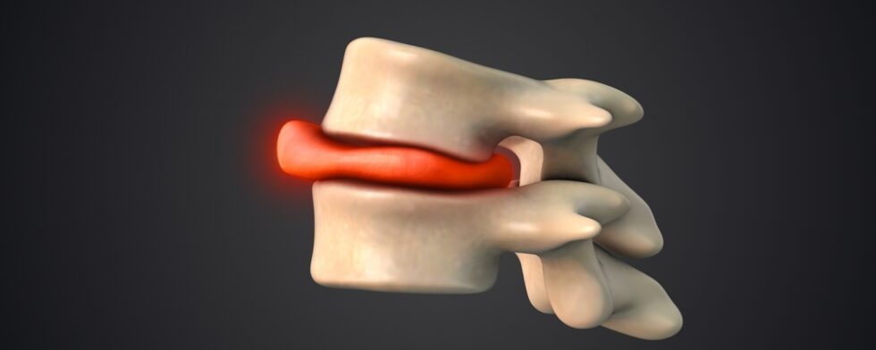 What Are The Red Flags Of A Herniated Disc